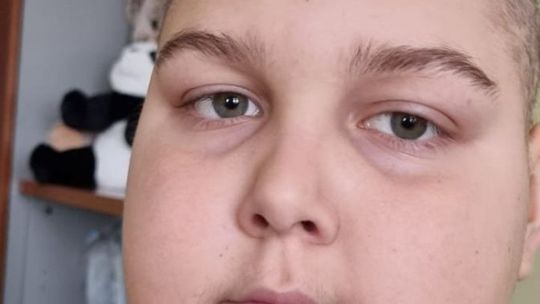 Dla 12-latka to terapia ostatniej szansy. Rodzice Radka potrzebują prawie 1,5 miliona złotych, żeby wygrać
