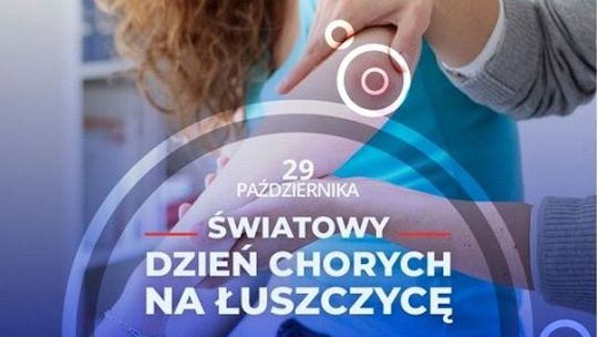 Łuszczyca – choroba przewlekła, ale nie zakaźna