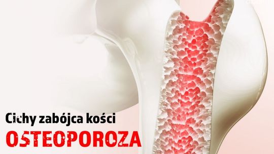 Osteoporoza - cichy złodziej kości 