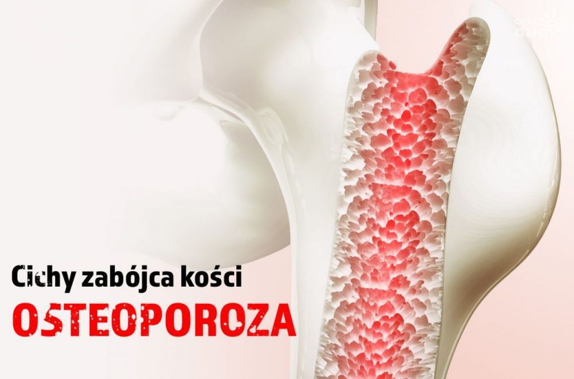 Osteoporoza - cichy złodziej kości Osteoporoza - cichy złodziej kości