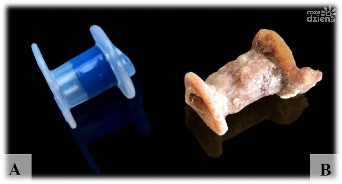 W ŚCO wynaleziono metodę zabezpieczania protez krtani W ŚCO wynaleziono metodę zabezpieczania protez krtani